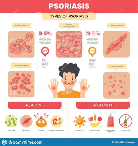 Psoriasis Infographic Human Skin Infection Psoriasis Diagnosis Vector