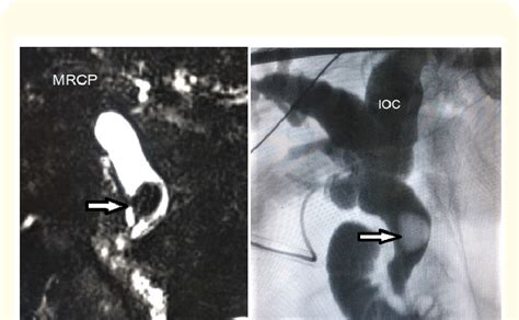 mrcp and intraoperative cholangiogram ioc demonstrating download scientific diagram