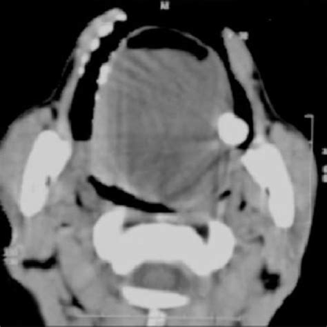 Ct Scan Showing A Hypodense Lesion With Peripheral Enhancement Within