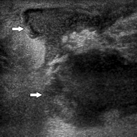 Nonpuerperal Mastitis And Subareolar Abscess Of The Breast Ajr