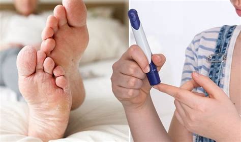 Type 2 Diabetes Symptoms Dry And Cracked Skin On Feet Is A Sign