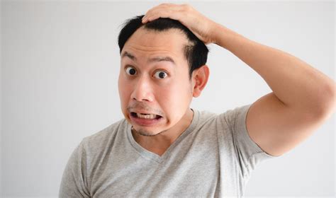 A Detailed Guide To Male Pattern Baldness And The Treatments Ironmag