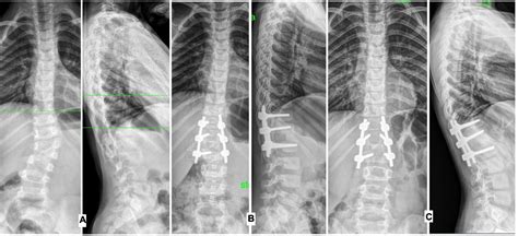 Frontiers The Results Of Surgical Treatment Of Preschool And Primary