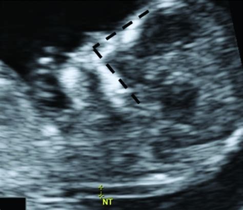 First And Second Trimester Sonographic Screening For Fetal Down