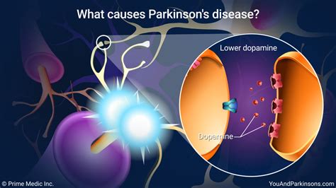 Slide Show Understanding Parkinsons Disease
