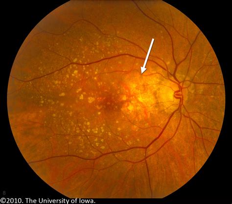 Age Related Macular Degeneration Progression From Atrophic To