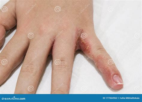 Child Hand Witn Eczema Atopic Dermatitis Between Fingers Stock Photo