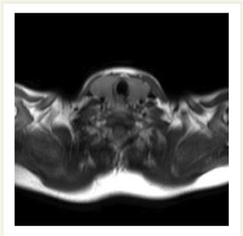 Figure 3 From A Case Report Of Acute Myopericarditis Associated With