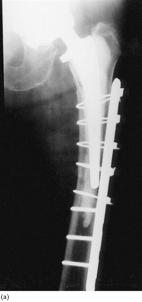 Dallmiles Cable And Plate Fixation For The Treatment Of Peri