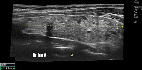 Ultrasound Imaging Panoramic Views Multinodular Goiter