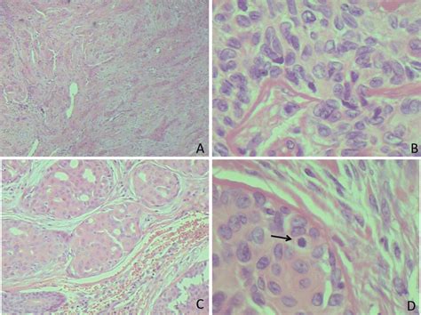 Eccrine Porocarcinoma Histology A Diffuse Infiltrative Pattern B