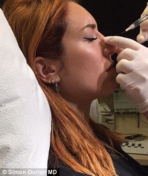 Numbing cream is applied on the area to be corrected. Would YOU have a non-surgical nose job? - Private Dentist ...