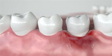 Gum Disease Lexington Ky Bluegrass Dentistry