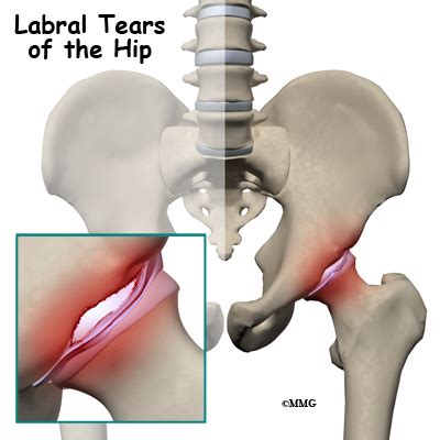 Labral Tears Of The Hip Osteopathy And Physiotherapy In Northampton