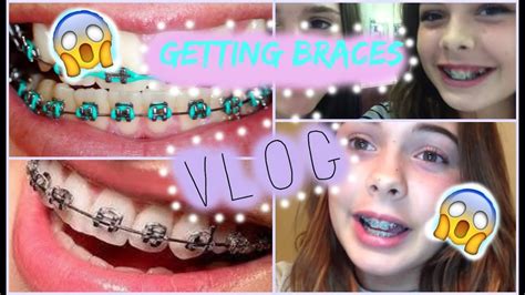 Braces Vlog I Got Braces Putting Braces On 🚂🚂 Youtube