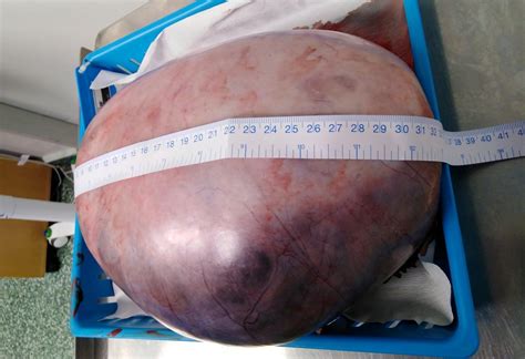 Woman Looked Pregnant Before She Had A Huge Tumour The Size Of A