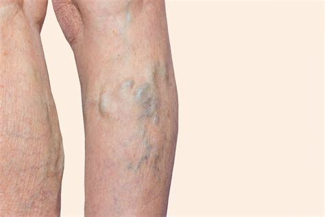 Varicose Veins Dont Ignore The 3 Symptoms Startme