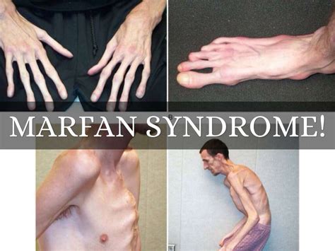Sindrome De Marfan Genetica Sololearn