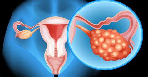 Researchers Find New Target For Drug Resistant Ovarian Cancer