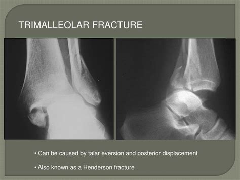 Ppt Ankle Fractures Powerpoint Presentation Free Download Id6596983