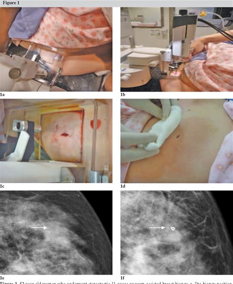 Pdf Stereotactic 11 Gauge Vacuum Assisted Breast Biopsy Experience