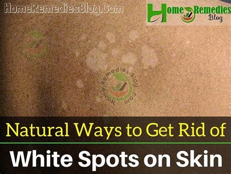 How To Get Rid Of White Spots On Skin Naturally Get Well Skin Spots