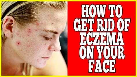How To Get Rid Of Eczema On Face Clinton Conley