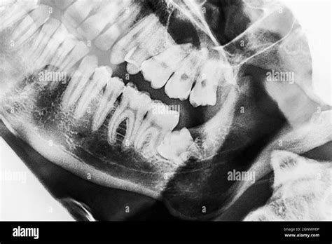 Wisdom Teeth X Ray Hi Res Stock Photography And Images Alamy