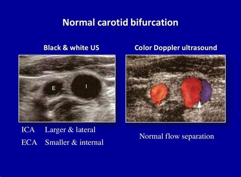 Doppler Ultrasound Of Carotid Arteries