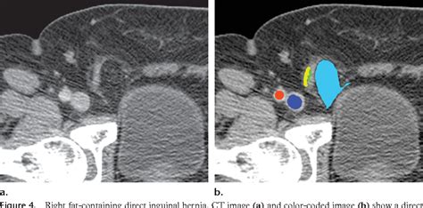 Figure 2 From Diagnosis Of Inguinal Region Hernias With Axial Ct The
