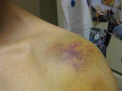 Bruised From Treatment At The Institute Of Living Wagblog Dum Spiro Spero