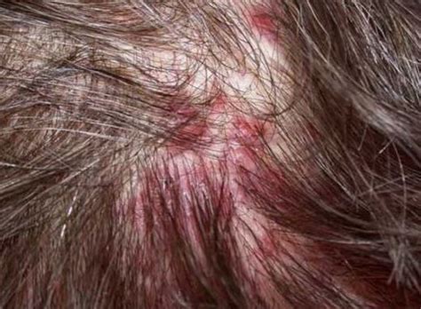 17 Best Images About Pimple Like Bumps On Scalp On Pinterest Small