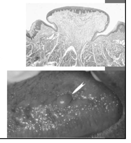 Mesenchymal Lesions In Oral Soft Tissue Flashcards Quizlet