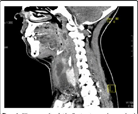 Figure 1 From Incomplete Ring Of Cervical Abscesses Semantic Scholar