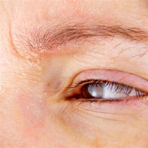 Eczema On Eyelid