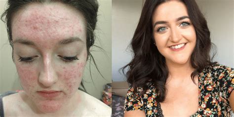 My Acne Story How Roaccutane Changed My Life Orlagh Claire