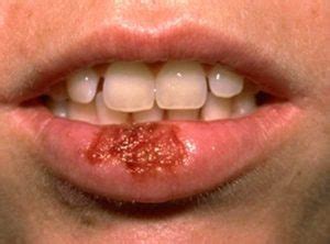 Herpes simplex is a viral infection caused by the herpes simplex virus. Vaginal Herpes Pictures | herpes symptoms, New Worldwide Estimates For Herpes Simplex Virus Type ...