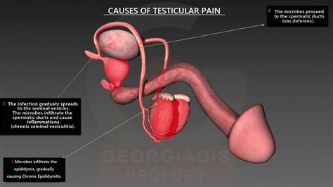 The other inflammations also cause pain in testis. Causes of Testicular Pain - Dr. Pavlos Georgiadis ...