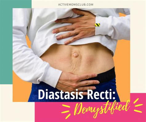 Diastasis Recti What You Need To Know Active Moms Club