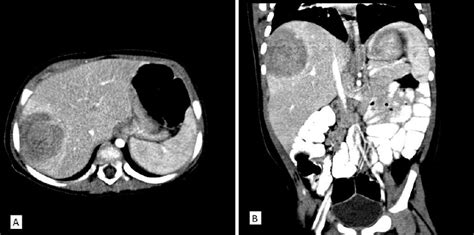 Contrast Enhanced Ct Scan Of The Liver A Cross Section B Sagital