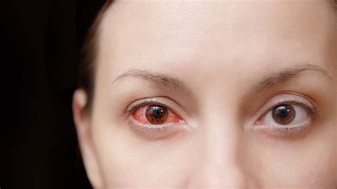 What Causes Pink Eye And How Do You Get Rid Of It Allure