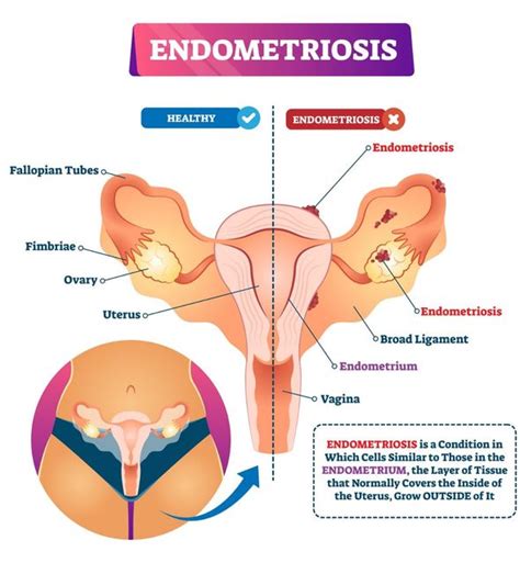 endometriosis how do i know if i have endometriosis how do you cure it uk