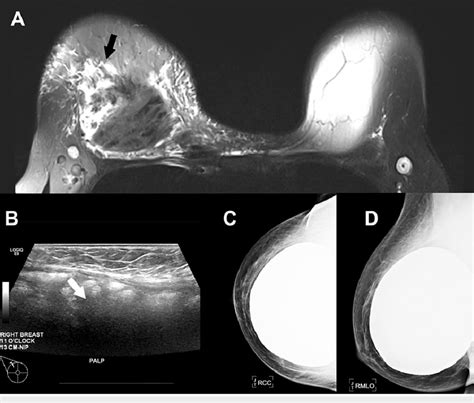 A Magnetic Resonance Imaging Shows Prepectoral Silicone Implant With