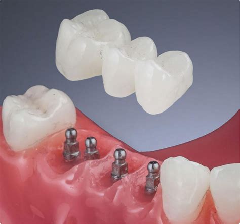 Mini Dental Implants Luxden Dental Implants Center Brooklyn Ny