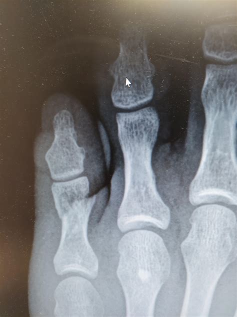 Fractured My Toe Xray Revealed My Distal And Middle Phalanges Have