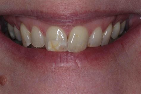 Composite Bonding Teeth Before And After Teethwalls