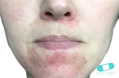 Find answers to health issues you can trust from healthgrades.com. Online Dermatology - Perioral Dermatitis