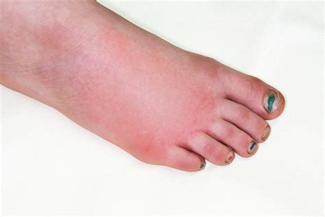 Allergic Reaction To Insect Bite Photograph By Dr P Marazzi Science Photo Library