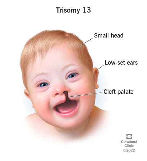 Trisomy 13 Patau Syndrome Symptoms Causes And Outlook