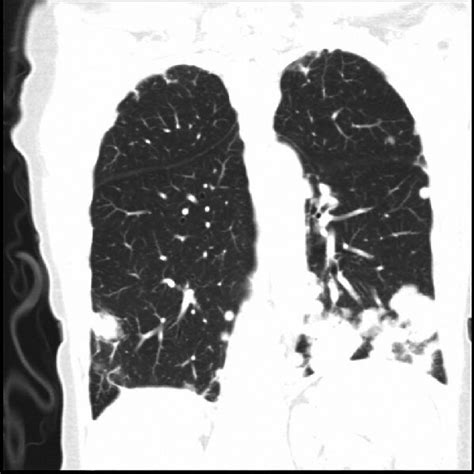 Chest Ct Multilobar Pneumonia Download Scientific Diagram